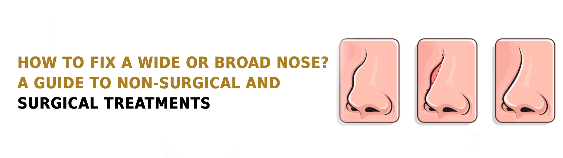 How to Fix a Wide or Broad Nose? A Guide to Non-Surgical and Surgical Treatments