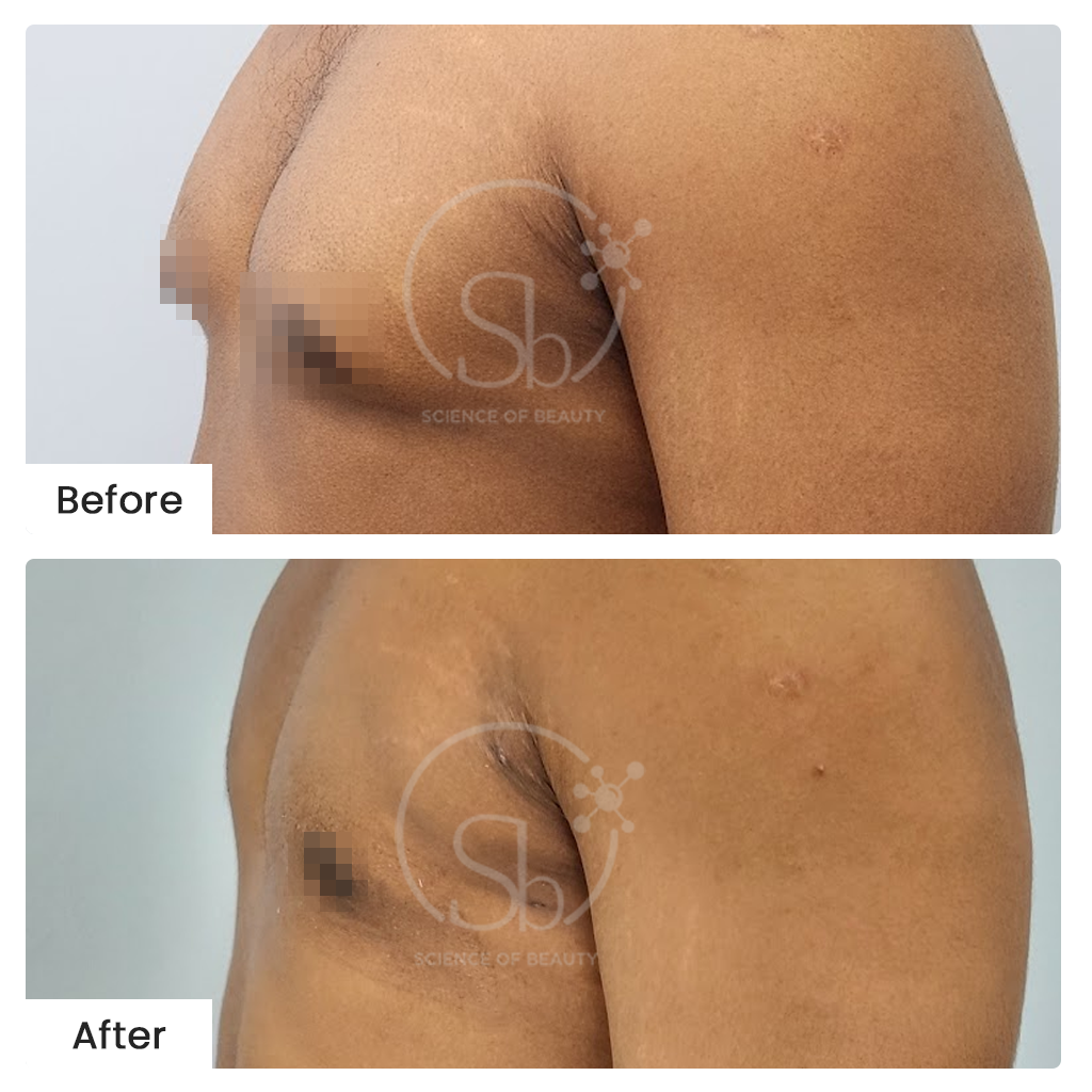 Gynecomastia Surgery Before-After Results