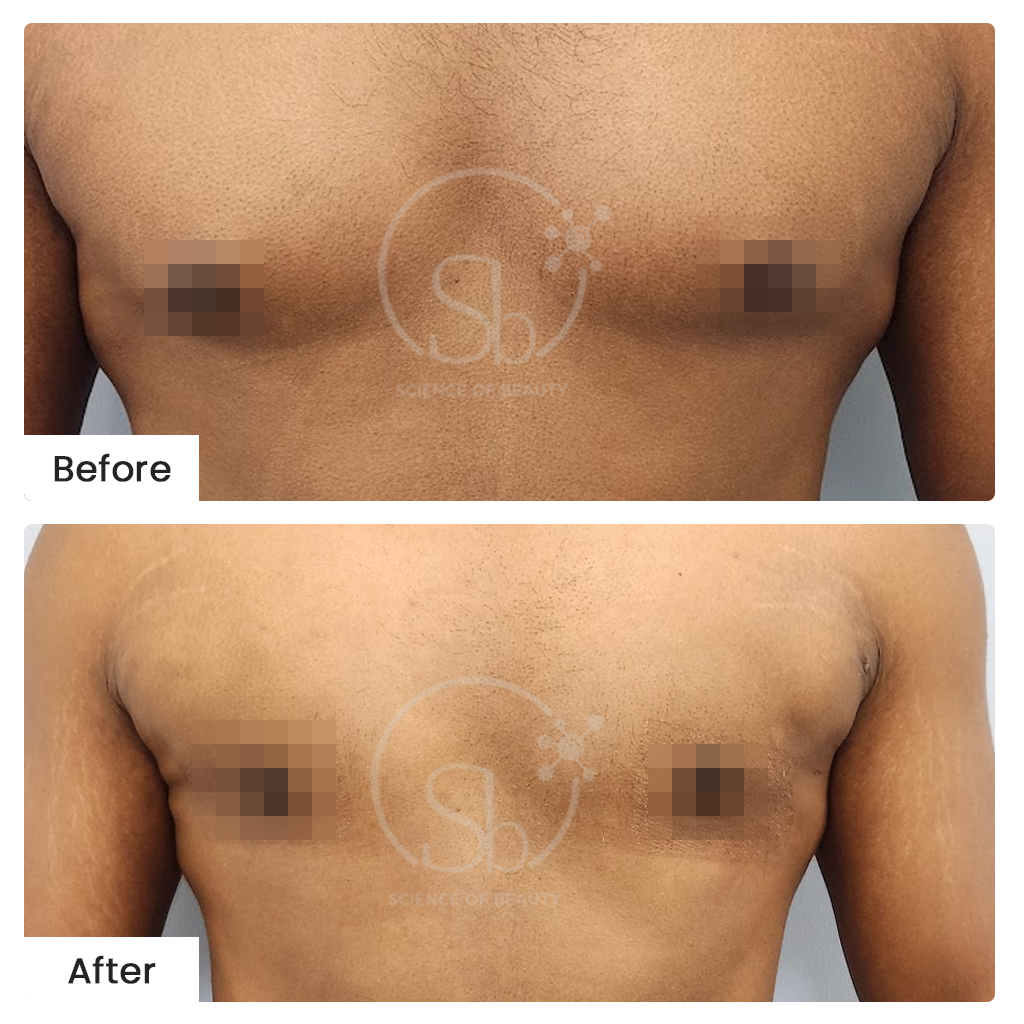 Gynecomastia Surgery Before-After Results