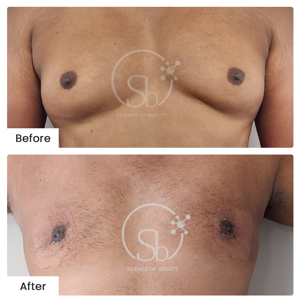 Gynecomastia Surgery Before-After Results