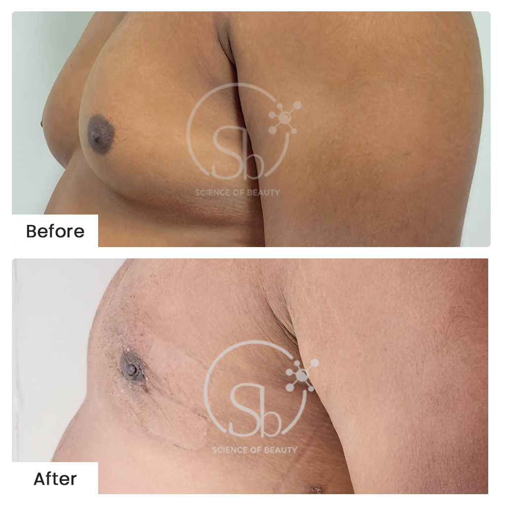 Gynecomastia Surgery: Before-After